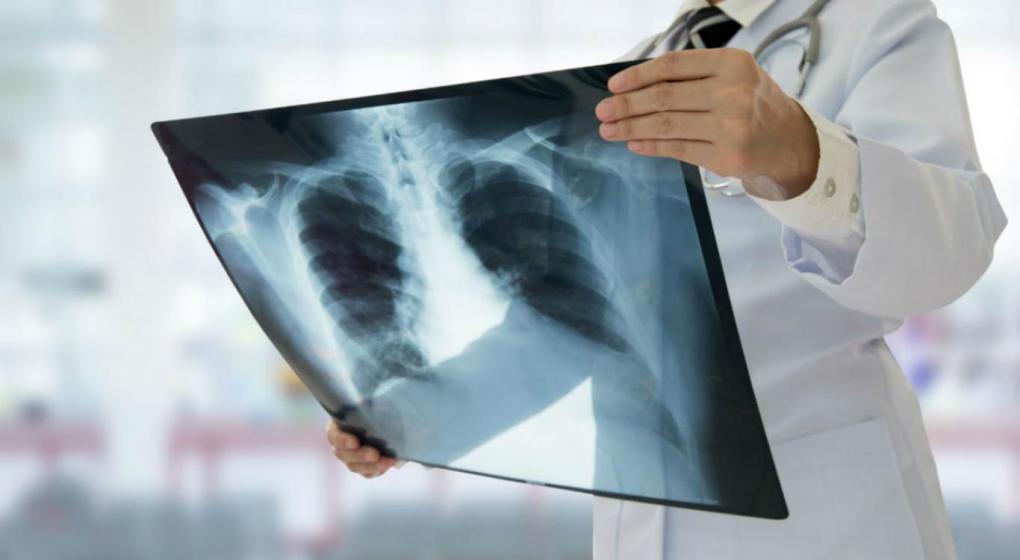 Por nuevos casos mortales, especialistas de la Universidad de La Plata explican cómo cuidarse de la tuberculosis